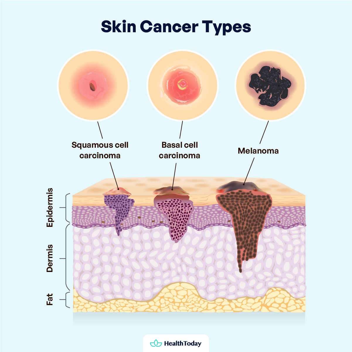 Can You Die From Skin Cancer Survival Rates and Preventions 01